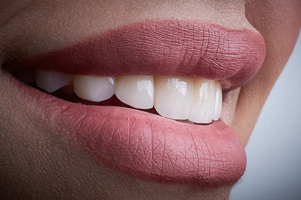 Dental Bonding: An Effective Way To Improve Your Smile