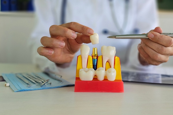 Dental Restoration    : Should I Get A Dental Crown Or Filling?